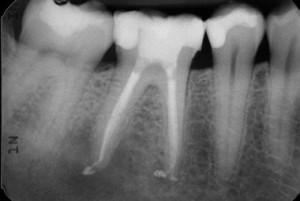 root canal and tooth