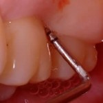 gum disease checks
