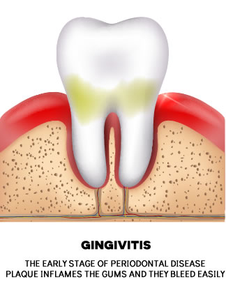 Gingivitis – Is Mild Gum Disease Something You Should Be Worried About?