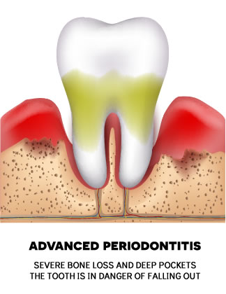 Periodontitis And The Threat To Your Teeth