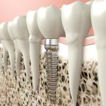 dental implant in bone