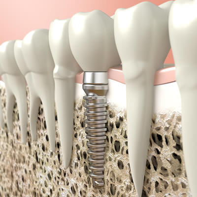 Are Dental Implants Painful To Have?