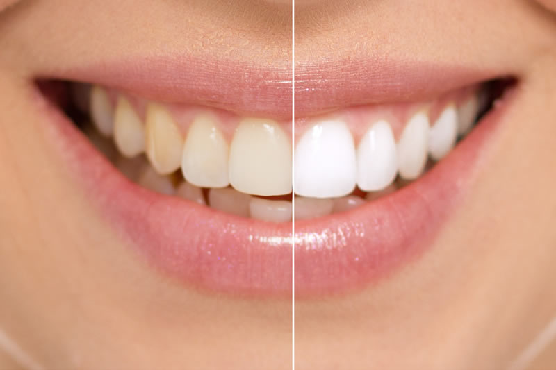 What causes stained and discoloured teeth?