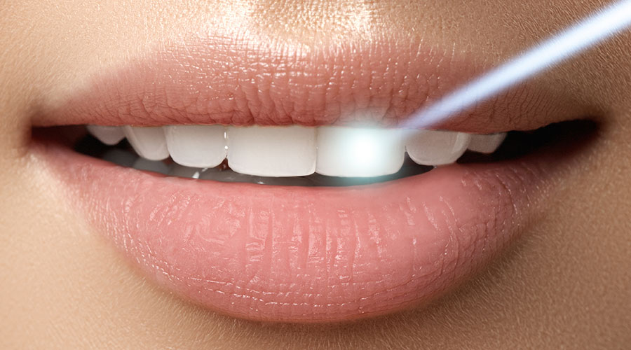 Illegal Teeth Whitening Is Not Worth The Risk