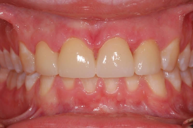 Dental Crowns Essex Tooth Crowns Chelmsford from Blue Sky Dental